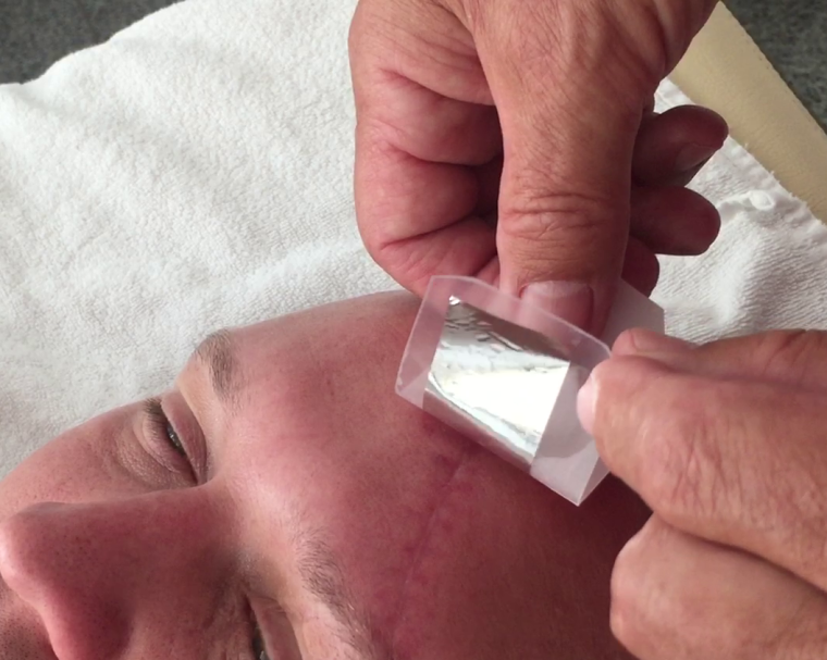 Abb. 4c: Bei Abnahme der Spezialfolie zeigt sich die Narbe deutlich reduziert.