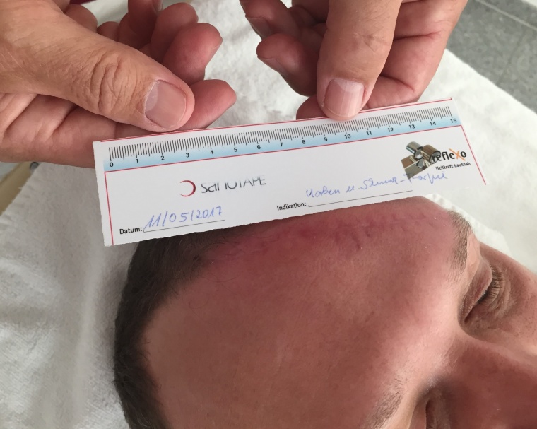 Abb. 4d: Ergebnis, nachdem die Narbe knapp zwei Monaten behandelt worden ist.