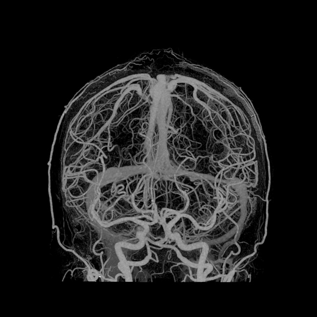 Ultra-Hochauflösende-CTA des Schädels des Aquilion Precision CTs von Canon...