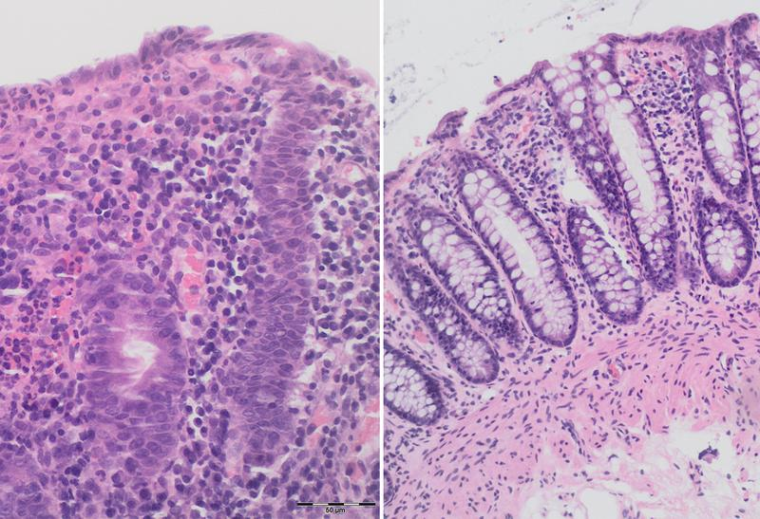 Unterschied auf Zellebene: Während vor der Therapie das Gewebe unstrukturiert...