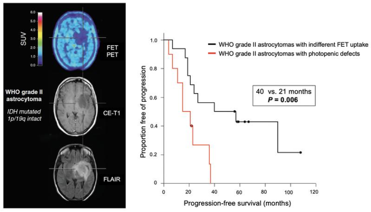 Patient mit niedriggradigem hirneigenen Tumor, der einen photopenischen Defekt...
