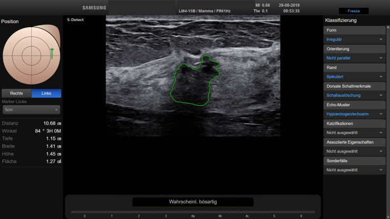 Invasiv lobuläres Mammakarzinom in dichtem fibroglandulären Gewebe.