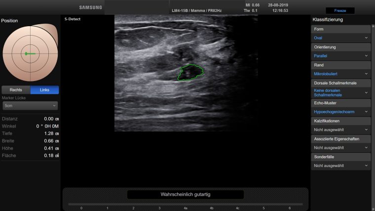 Kleiner Restherd nach neoadjuvanter Chemotherapie, der sich postoperativ nur...