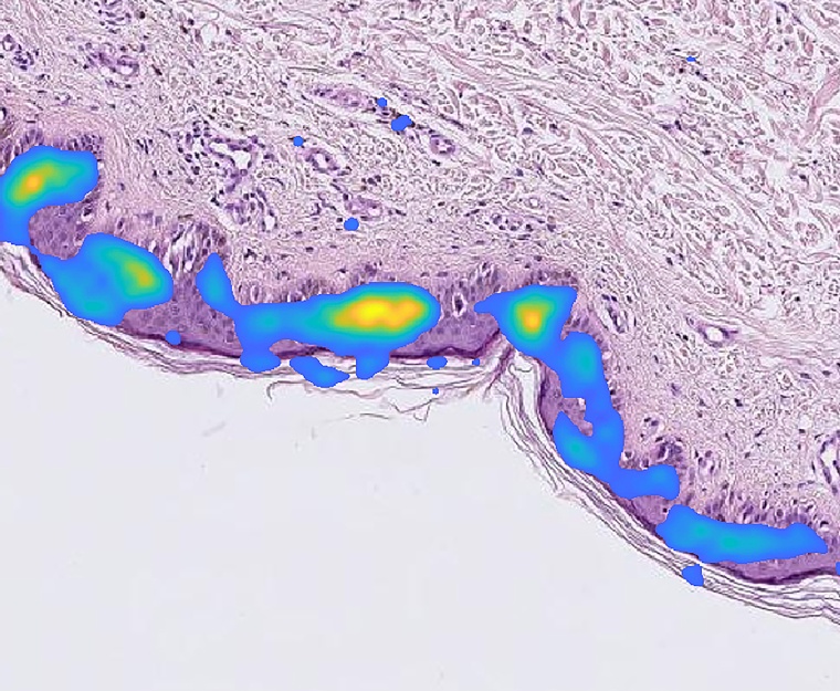 Gewebeschnitt einer Hauttumor-Probe, bei dem eine für die Diagnose wichtige...