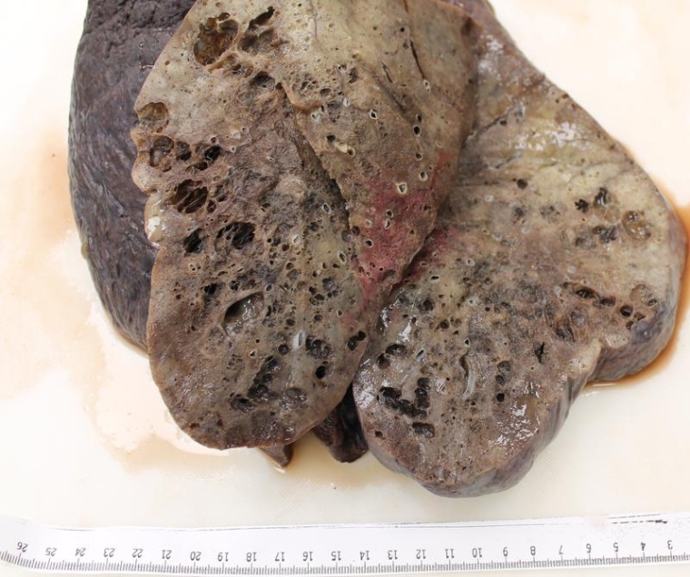 Mikroskopisch sichtbare ausgedehnte Fibrosierung des Lungengewebes und...