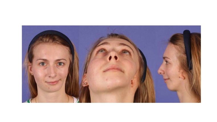 Abb. 1: Pat. mit Goldenhar-Symptomenkomplex und den typischen klinischen...