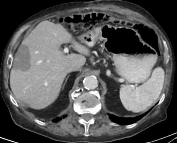 3 Monate nach Mikrowellenablation Nekroseareal im Segment 8 des rechten...