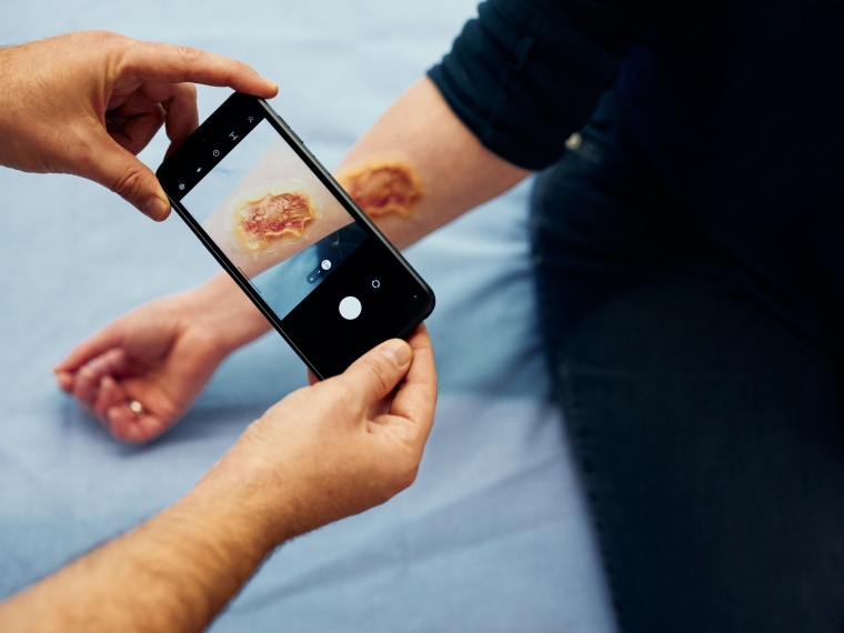 Mittels eines Smartphones wird die Wunde gescannt. Die KI gibt eine...