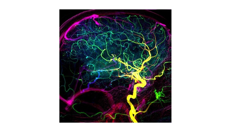 Darstellung der Blutgefässe im Gehirn eines Patienten mit früher venöser...