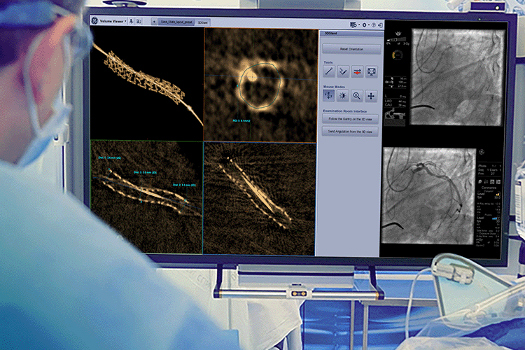 3D-Stent Foto: GE HealthCare