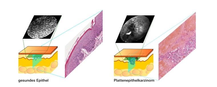 Die konfokale Laserendomikroskopie (CLE) macht die Zellorganisation sichtbar...