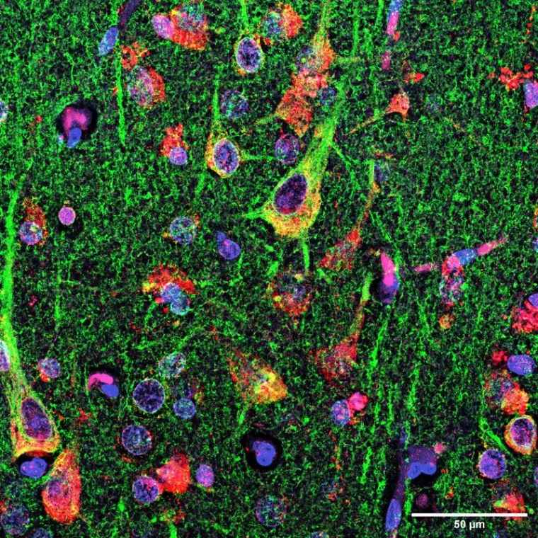 Im Mikroskop: In dem Gehirnschnitt eines MS-Patienten sind die Neurone grün...