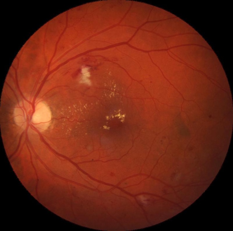 Fundusaufnahme für Netzhaut-Screening mittels KI Foto: Augen-Praxisklinik...
