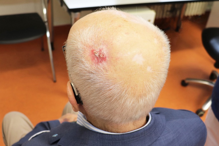 Die Wunde am Kopf von Patient Dr. Franz Robertz heilt dank...