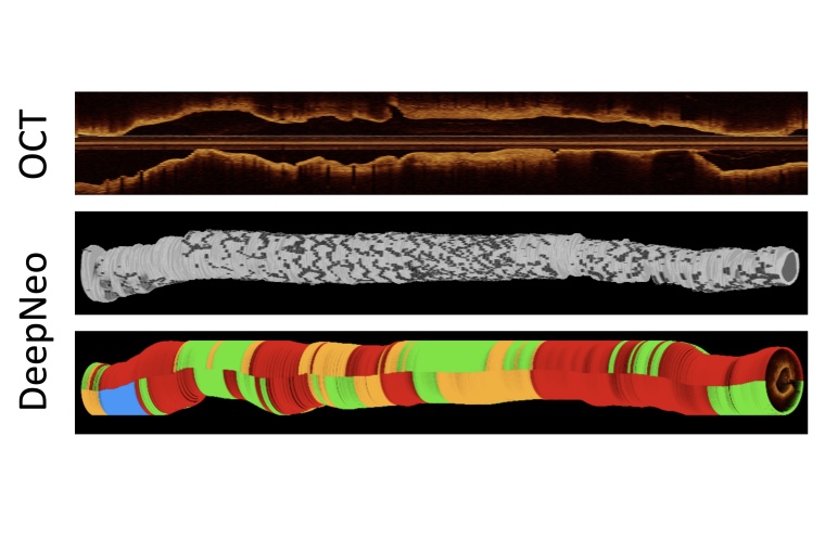 Photo: KI erleichtert die Nachsorge nach Stent-OPs