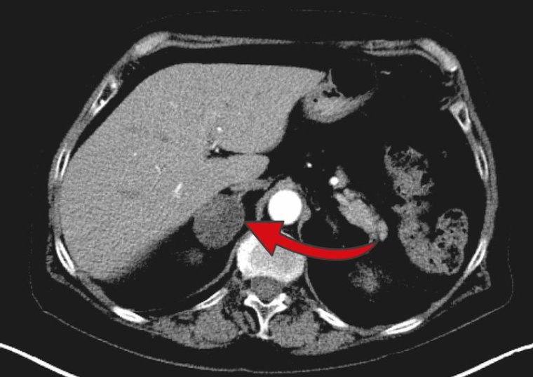 Das MRT zeigt einen drei Zentimeter großen Nebennierentumor auf der rechten...