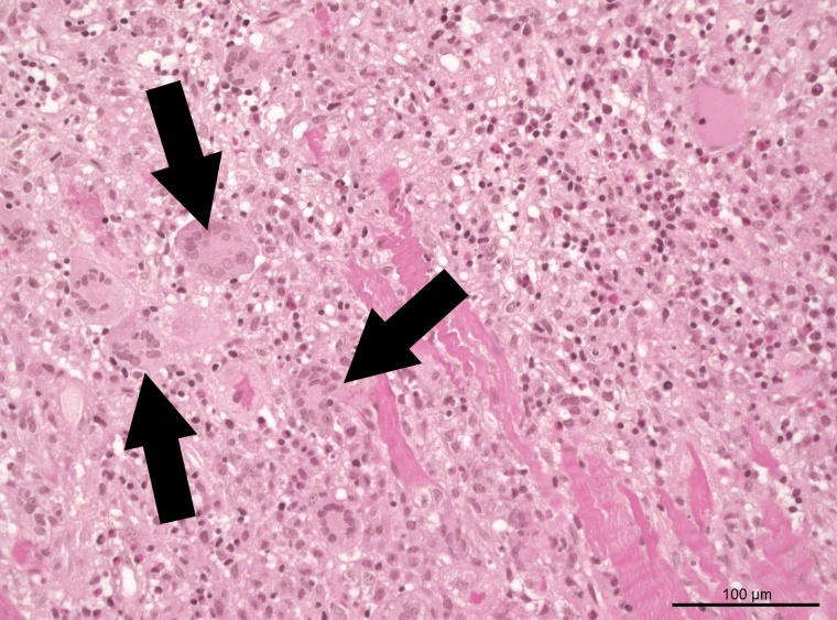 In der Mikroskop-Aufnahme einer Gewebeprobe aus einem erkrankten Herzmuskel...