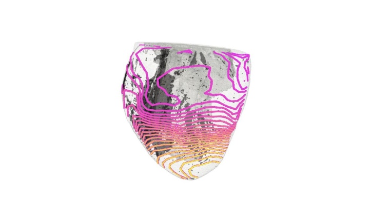 Die elektrische Erregungsausbreitung (farbig) auf einem Herz ist sehr...