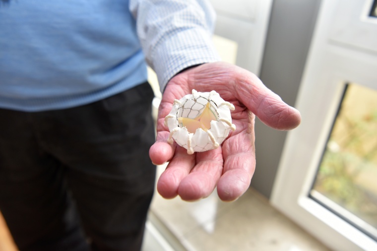 So sieht die Klappenprothese aus, die im Herzen von Hans-Peter Wetzig...