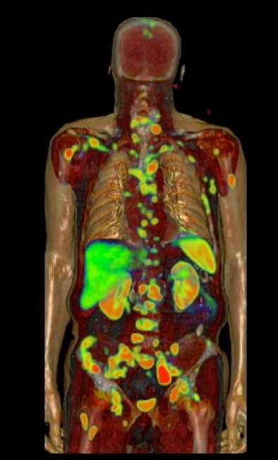 Das neue radioaktive Kontrastmittel markiert Metastasen besser als gängige...