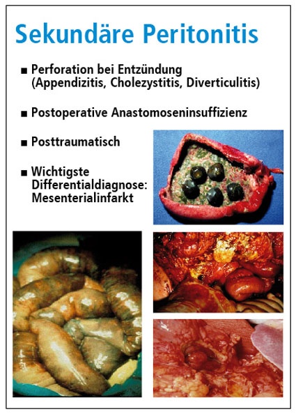 Beispiele von sekundärer Peritonitis (Prof. W. Krüger, Konstanz).