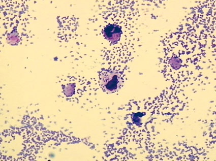 Bakterielle Meningitis