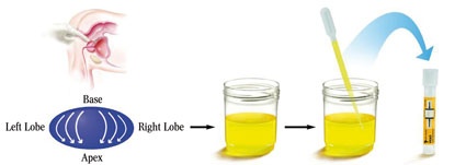 Die Urinprobe soll nach rektaler Untersuchung des Patienten unmittelbar nach...