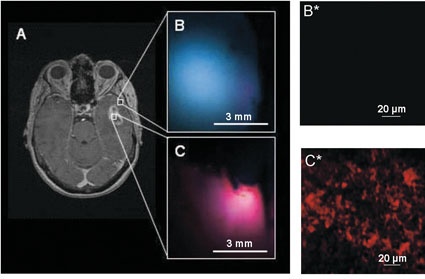 Magnetresonanztomografie zeigt ein Gliom vom Tumorgrad IV (A). Der...