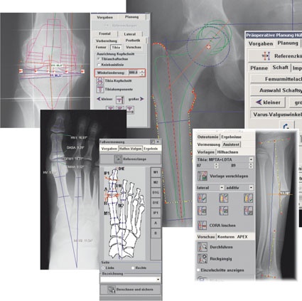 Implantationen von Hüft- Knieendoprothesen können direkt in der digitalen...