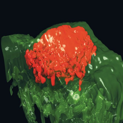 3-D-Rekonstruktion eines knotigen Basalzellkarzinoms (Quelle: TRM...