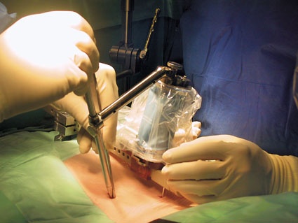 In der Wirbelsäulenchirurgie ermöglichen heute robotergesteuerte...