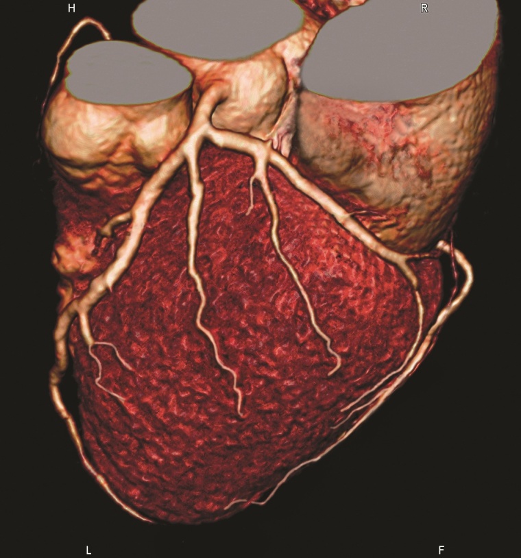 Eine neue Studie zeigt, dass sich mit der Dual-Source-Computertomographie die...