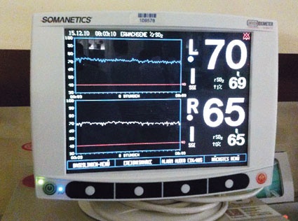 Bestimmung der cerebralen Sauerstoffsättigung. Foto: Universität Lübeck