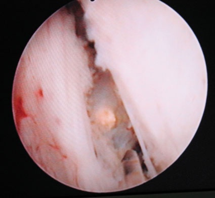 Mittels HoLEP ist eine genaue Inzision der Prostata möglich. Die Laserfaser...