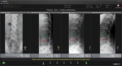Die vertaplan-Software ermöglicht dem Arzt die präzise Planung der...