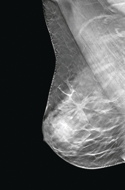 Die Entwicklungen der letzten Jahre führten zur Mammografietomosynthese, eine...
