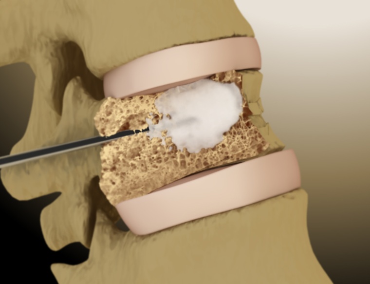 Speziell entwickelter Zement wird maschinell in den porösen Wirbelkörper...