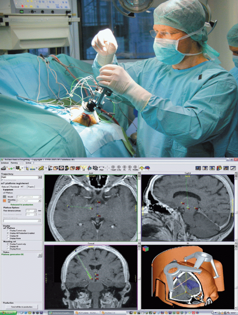 (oben) Abb. 1: Intraoperative Situation nach Montage der Stereotaxieplattform....