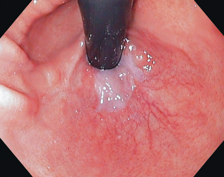 Endoskopische Aufnahme der Cardia in HDTV-Technik mit 1.080 Bildzeilen in...