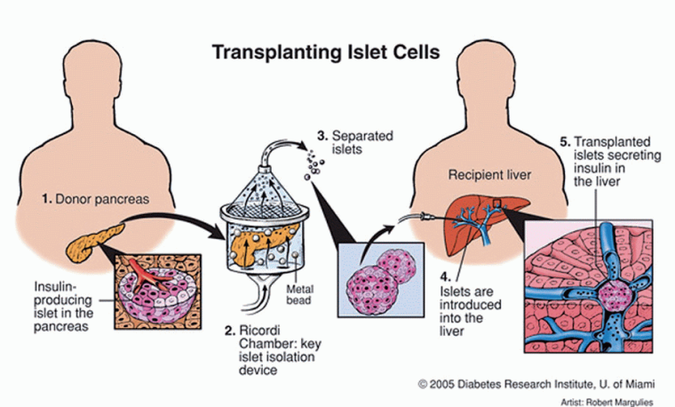 Inselzelltransplantation