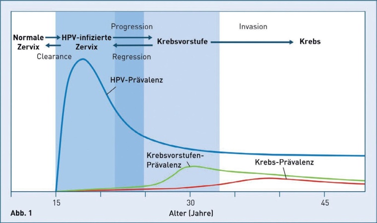 Abb. 1: Schematische Darstellung der Pathogenese HPV-induzierter...