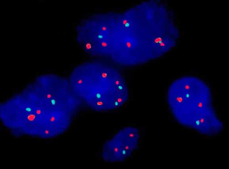 In den Kernen der Tumoren (im Bild blau) von Patienten mit langem Überleben...