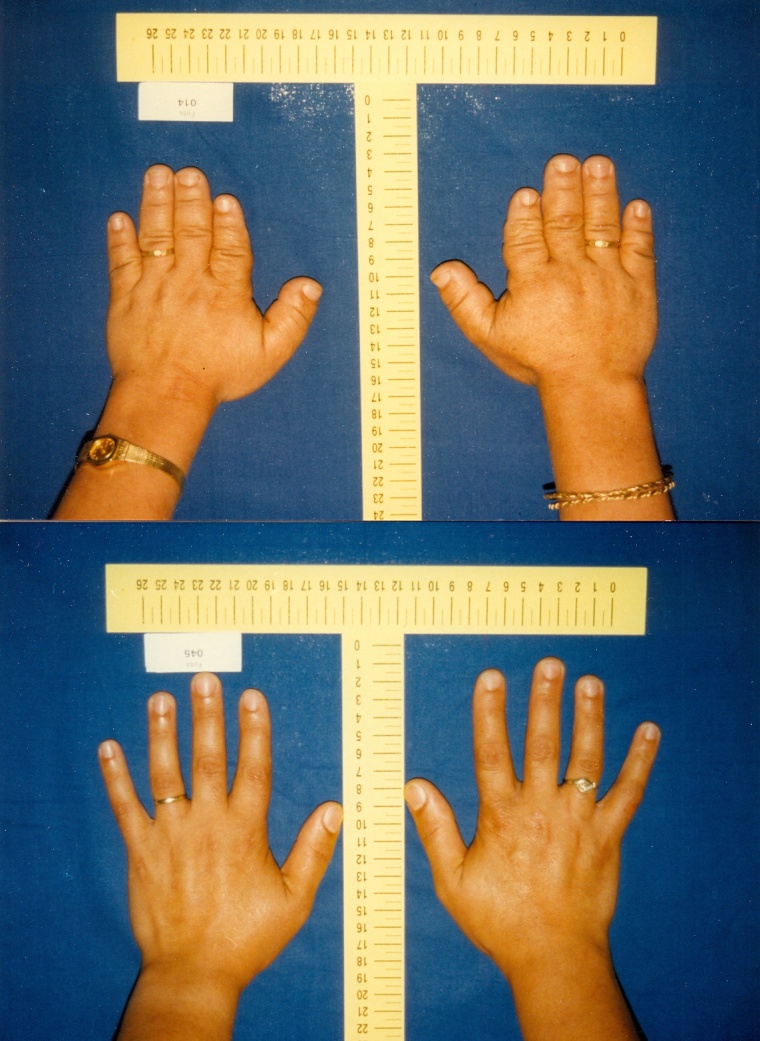 Die Brachydaktylie wird in einer türkischen Familie immer mit dem...