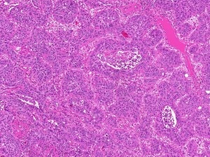 Histologisches Schnittpräparat eines primären Lungenkarzinoms. Foto:...
