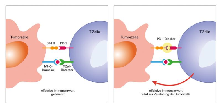 So wirkt die PD-1-Blockade prinzipiell. Bei Patienten mit fortgeschrittenem...
