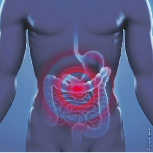 Colitis ulcerosa: Auf einem Satellitensymposium der Firma Shire während der...