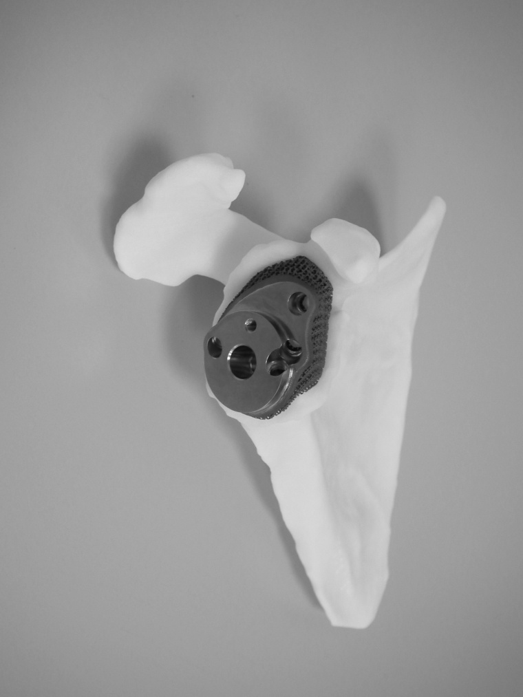 3D-gedrucktes Schulterimplantat aus Titan.
