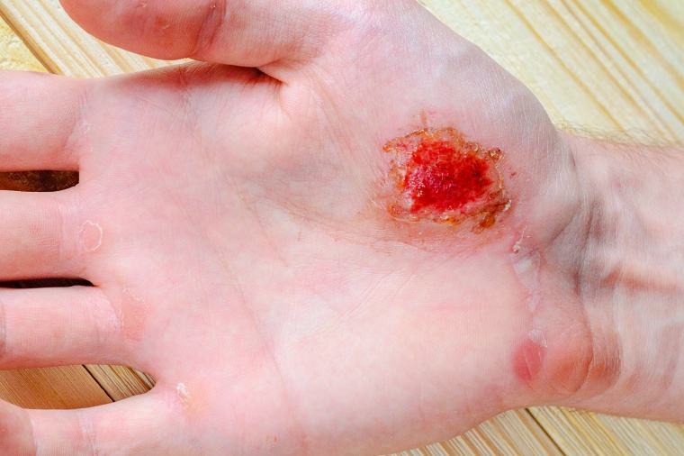 Bakterien auf der Haut können die Wundheilung beschleunigen. Foto: Wiley /...