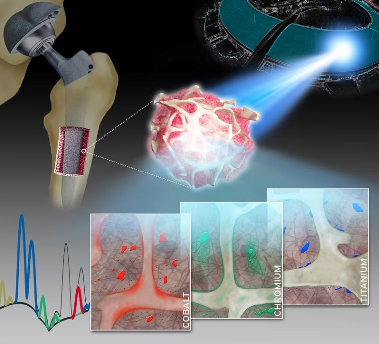 Räumlich hochaufgelöste Synchrotron-Röntgenfluoreszenzanalysen von humanen...