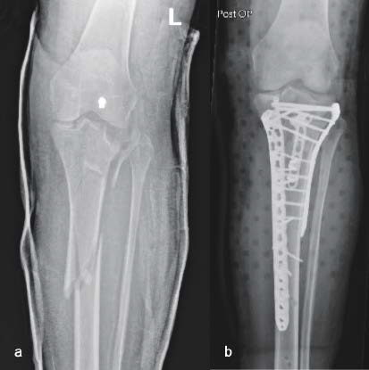 67-jährige Patientin mit komplexer proximaler Unterschenkelfraktur nach Sturz...